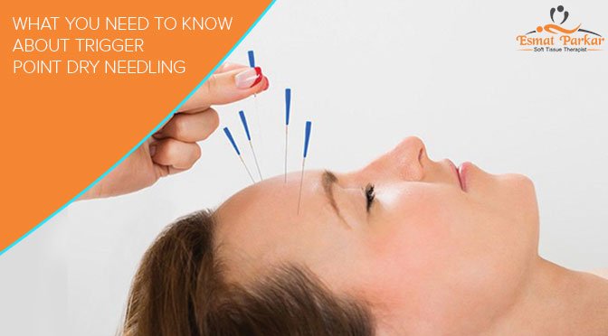 WHAT YOU NEED TO KNOW ABOUT TRIGGER POINT DRY NEEDLING